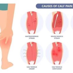 Calf Strain Treatment