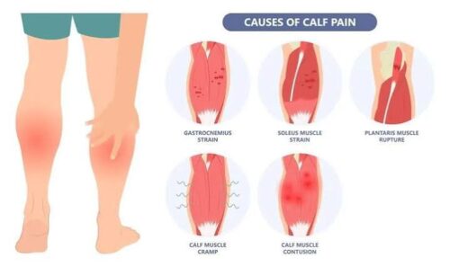 Calf Strain Treatment Calf Strain Treatment