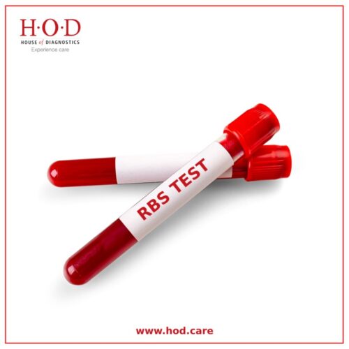Random Blood Sugar (Glucose) Random Blood Sugar (Glucose)