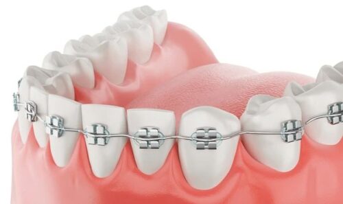braces-in-morton-grove (1) braces-in-morton-grove (1)